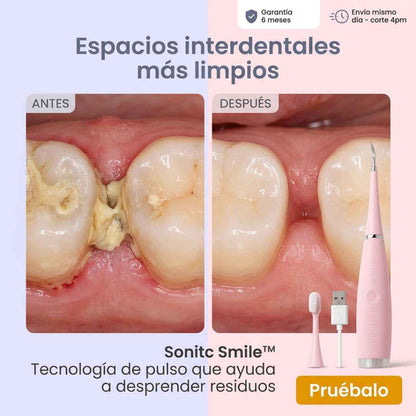 DESPRENDE SARRO Y MANCHAS EN CASA — SONIC SMILE™